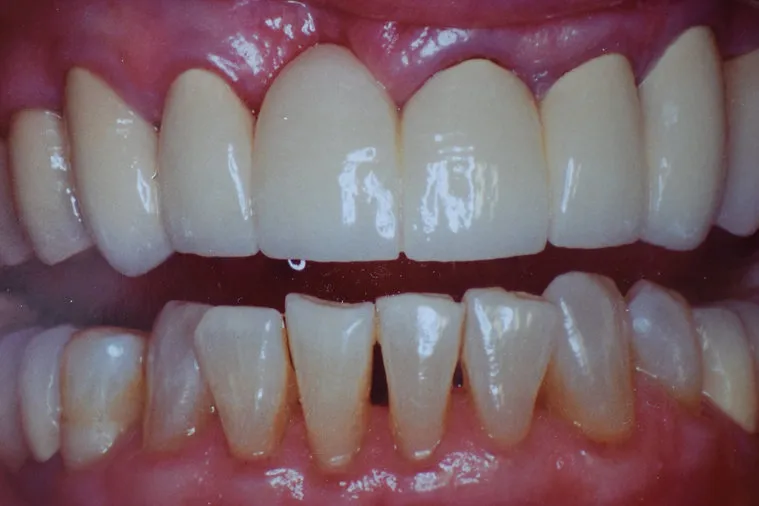 After dental treatment - improved smile