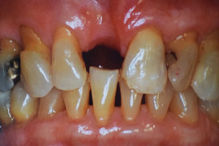 Before dental treatment