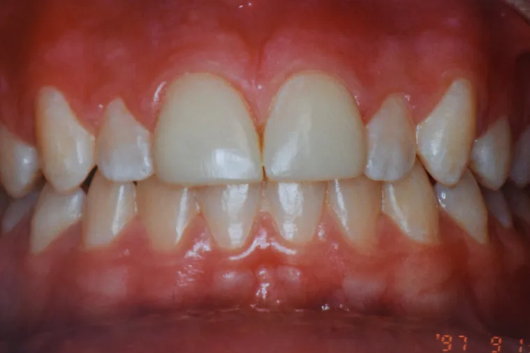 After dental treatment - improved smile