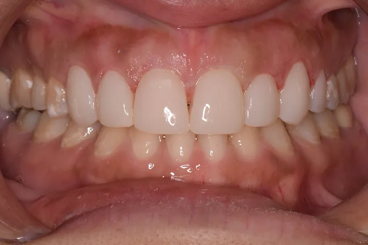 After dental treatment - improved smile
