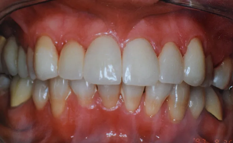 After dental treatment - improved smile