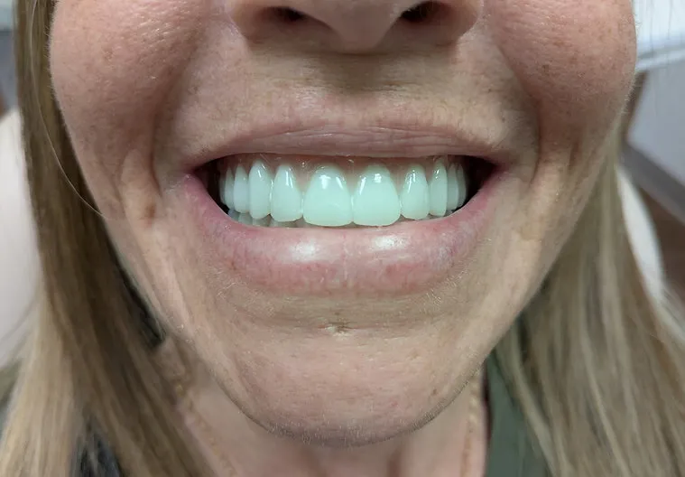 After dental treatment - improved smile