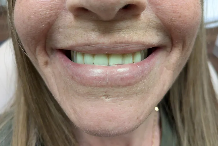 Before dental treatment