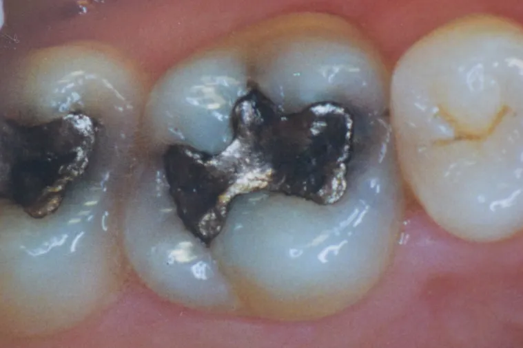 Before dental treatment