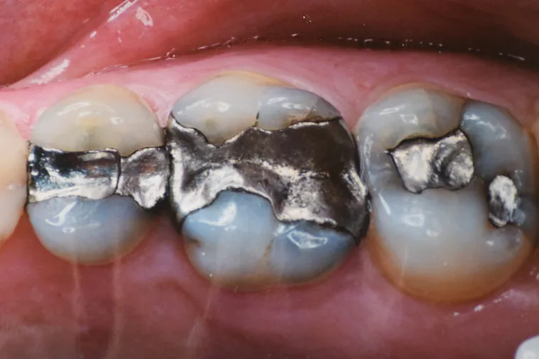 Before dental treatment