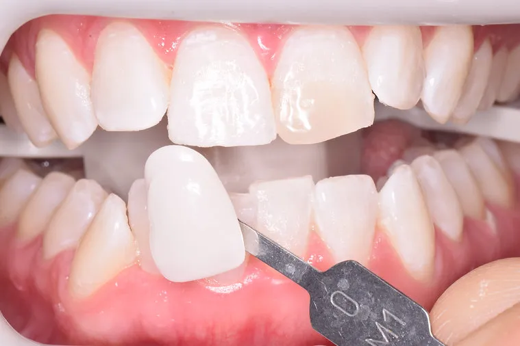 After dental treatment - improved smile